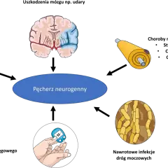 Pęcherz neurogenny może objawiać się problemami z oddawaniem moczu. Ilustracja pokazuje mózg, rdzeń kręgowy, nerw, cukrzycę i komórki nerwowe.