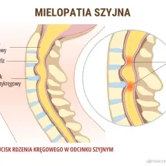 Ucisk na rdzeń kręgowy w odcinku szyjnym, prowadzący do mielopatii i potencjalnego drętwienia barku. Widoczne osteofity i krążki międzykręgowe.