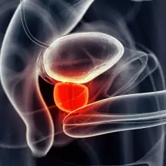 Anatomical illustration of male urinary system, highlighting inflamed prostate causing przerywane oddawanie moczu u mężczyzn.