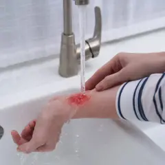 Ręka z poparzoną skórą pod bieżącą wodą z kranu.