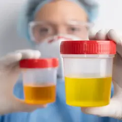 Medyk w rękawiczkach trzyma pojemniki z próbkami moczu. Jeden z nich może wskazywać na mocz z krwią i pieczenie.