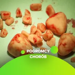 Kamienie w pęcherzu moczowym, usunięte podczas zabiegu.