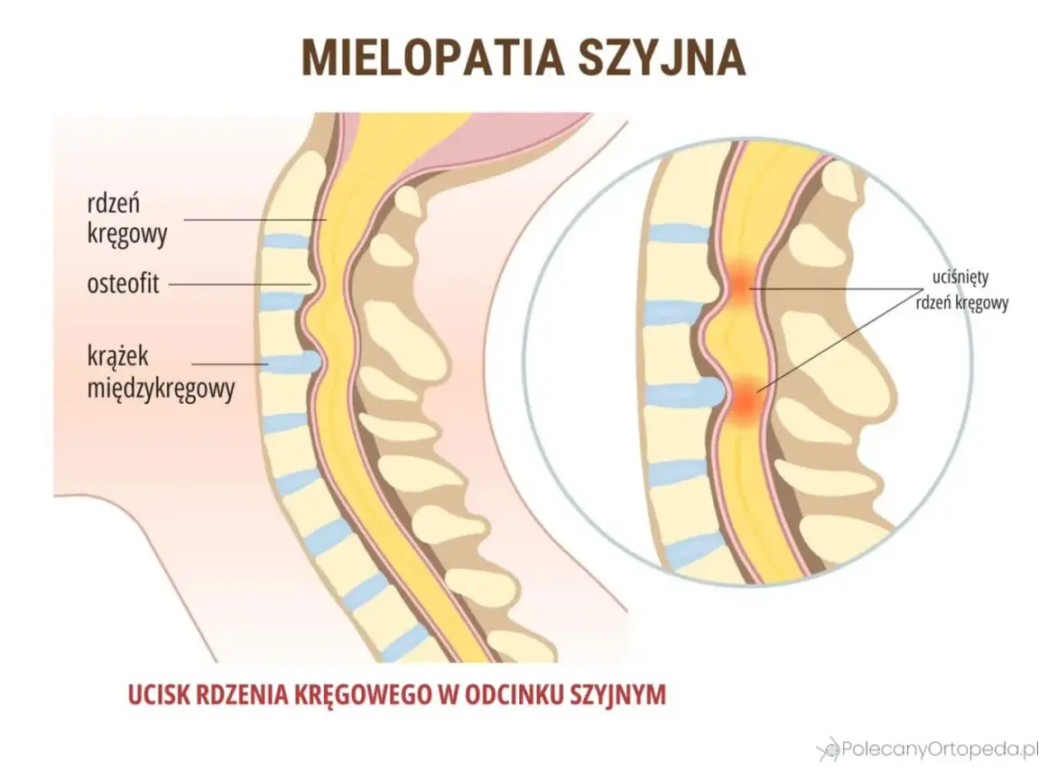 Ucisk na rdzeń kręgowy w odcinku szyjnym, prowadzący do mielopatii i potencjalnego drętwienia barku. Widoczne osteofity i krążki międzykręgowe.