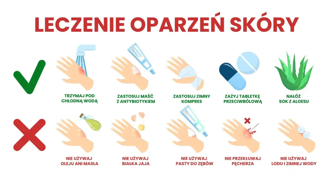 Oparzenie dłoni - co zrobić i kiedy iść do lekarza?