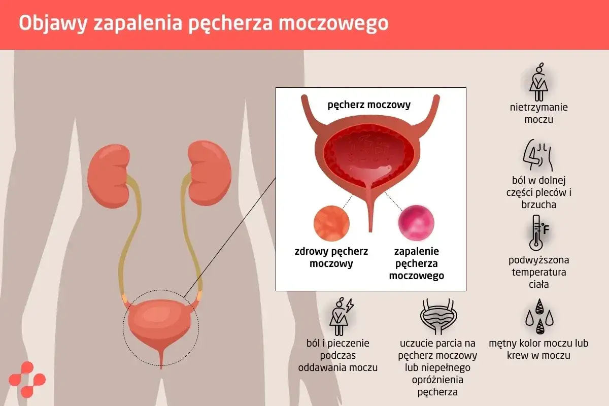 Ilustracja przedstawia objawy zapalenia pęcherza moczowego: ból, pieczenie, nietrzymanie moczu, gorączkę i mętny mocz.