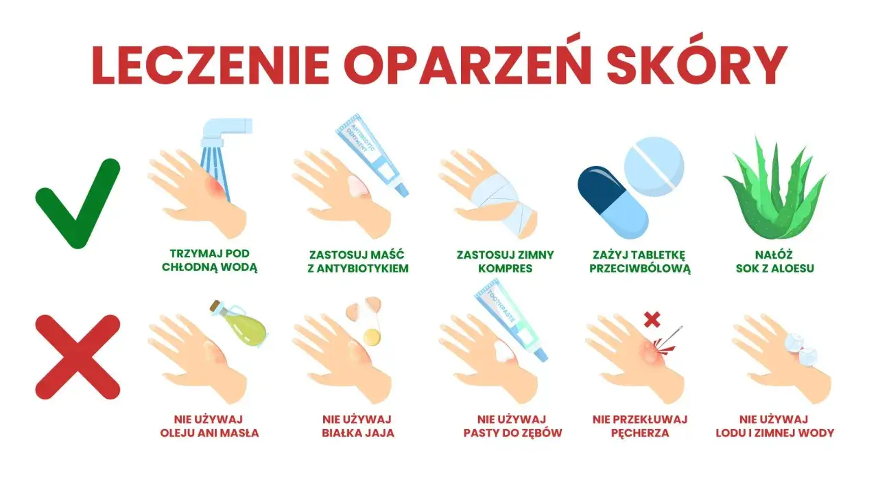 Ilustracja pokazuje, jak leczyć poparzoną skórę: chłodna woda, maść z antybiotykiem, zimny kompres, tabletki przeciwbólowe, aloes. Unikaj masła, jajka, pasty do zębów, lodu.